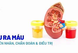 Đi Tiểu Buốt Ra Máu Là Bị Gì